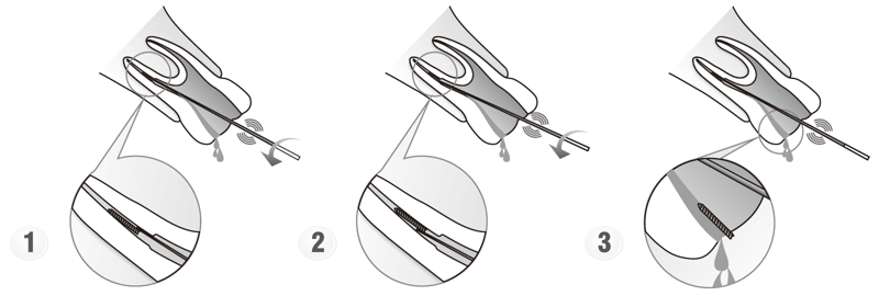 Сфера применения наконечника для скалера